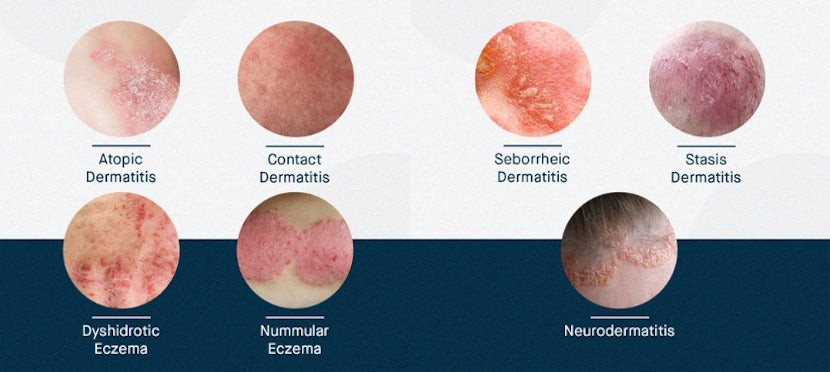 图源:https://slmdskincare.com/blogs/learn/everything-you-need-to-know-about-eczema