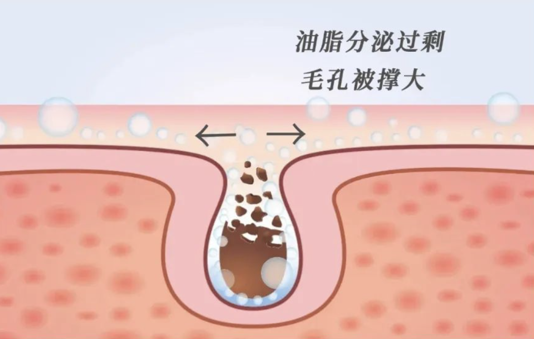 越上班黑头越多？！干皮也逃不过？